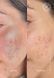 Сироватка з азелаїновою кислотою Theramid Azid Azelaic Acid 15% Treatment, 30 ml TH08 фото 3