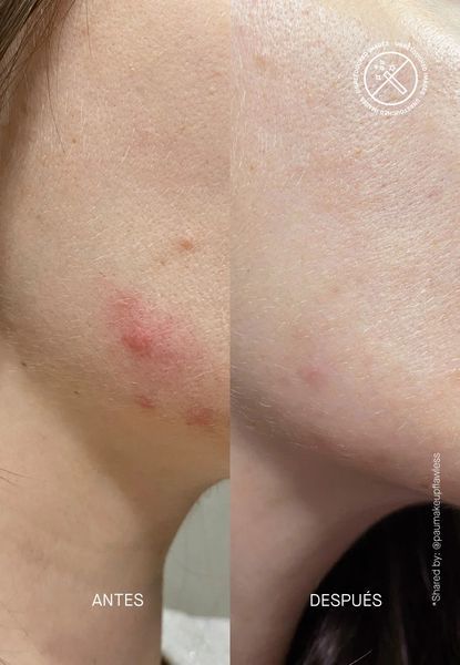 Сироватка від висипань Acnemy Postzit, 10 ml AC08 фото